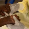 Brasil registra 88 casos de Mpox em 2026; saiba como evitar a doença